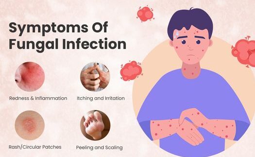 Top 10 Itraconazole Capsules Brands in India